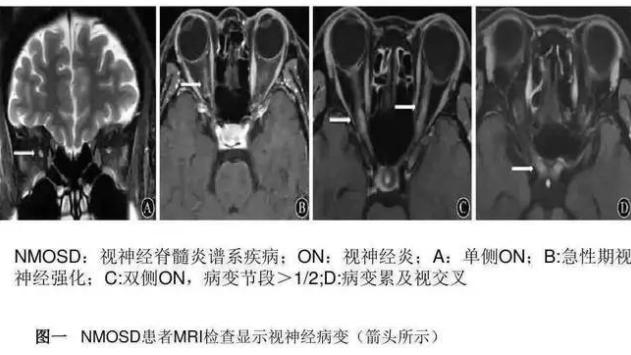 间充质干细胞治疗神经免疫性疾病的临床研究