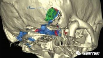 医生|脑肿瘤的精准化手术中医疗3D打印到底重不重要