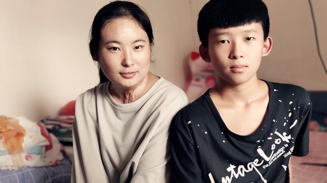 2018年姐姐被烧伤毁容，弟弟：姐，没人娶你，我养你一辈子