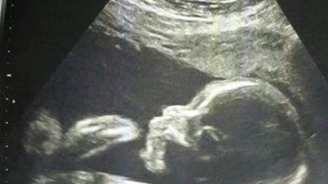 湖南女子生下“小猴子”，杂技团开价5万想买走，如今她现状如何