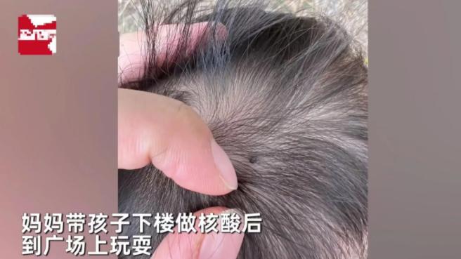 安徽合肥，女子带孩子去楼下做核酸，突然看到孩子头顶多了一颗芝麻大小的“黑痣”