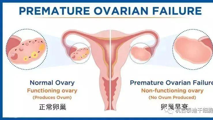 美国伊利诺伊大学：干细胞疗法成为治疗卵巢早衰的新方法