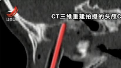 18年，2岁女童遭铅笔从上唇贯穿鼻腔，距眼眶仅一厘米，如今怎样了