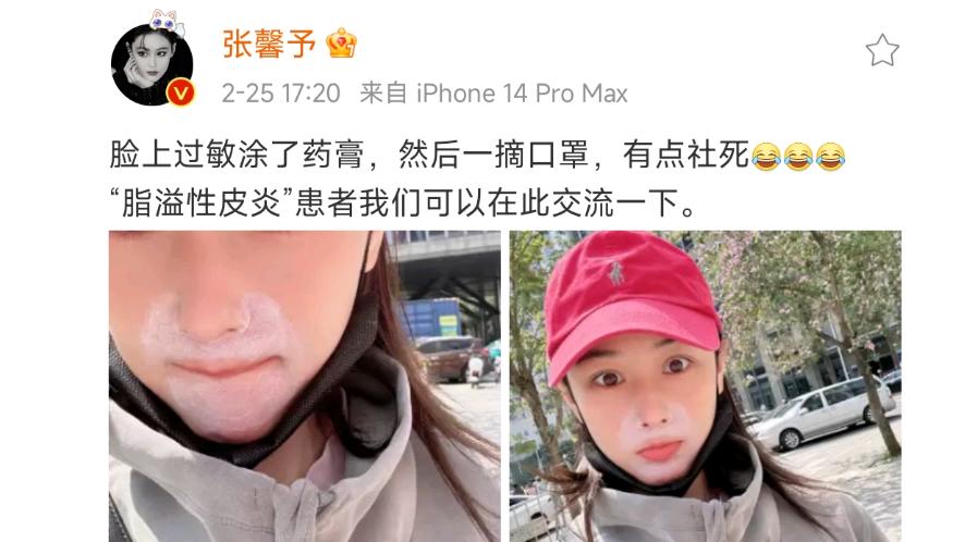 张馨予|张馨予患脂溢性皮炎，脸上涂药膏摘口罩后社死，网友打趣像熊大