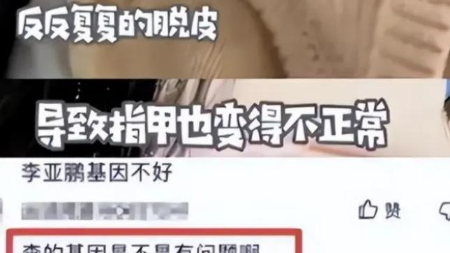 李亚鹏实惨！小女儿病情恐加重，眼睛、走路不对劲，被疑唐氏儿