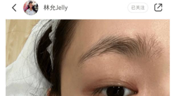 水果 27岁的林允晒去除皱纹照，脸上布满了针孔，直言整容要小心