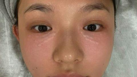 太真实！林允晒打水光针过程，画面高能，全程面不改色引争议