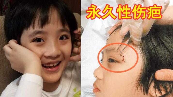 林凡|14岁费曼罕晒自拍！身高1米81肥头大耳，刘海遮伤疤疑陷容貌焦虑