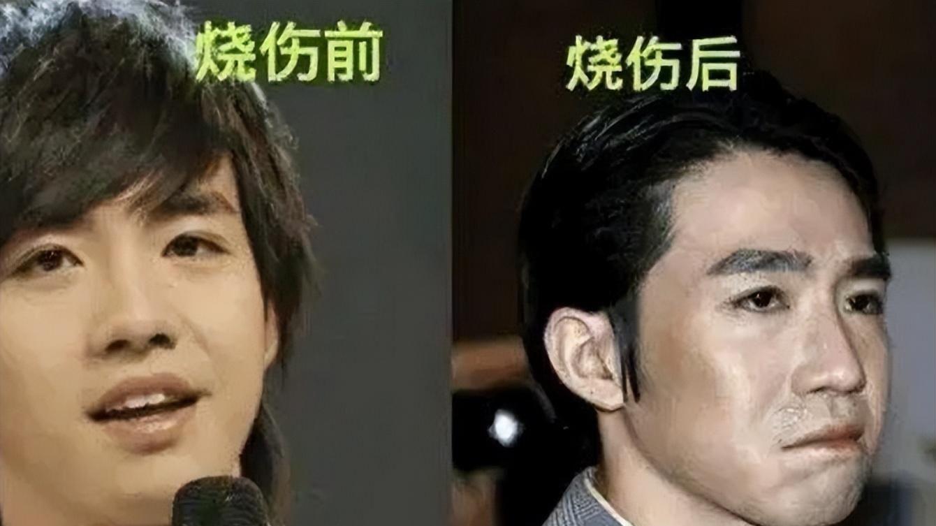 俞灏明：23岁毁容，被女友抛弃，公司放弃，如今大变身，是个狠人