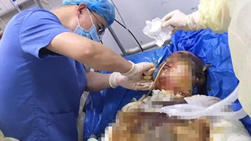 被男友泼滚烫热油，32岁女白领全身烧成炭，脓烂流黑水，只能绝望等死