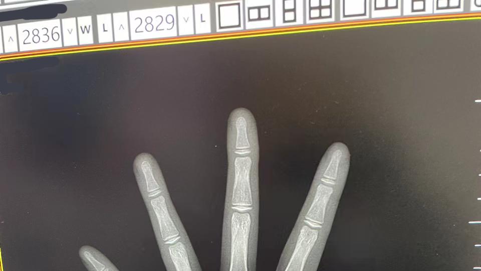 骨龄测评一定要让医生使用中华05当面判读