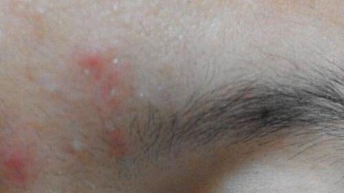 痘痘 艾妍赫提供一些有效的解决方法，帮助你们摆脱眉毛上的痘痘困扰
