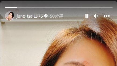 meta|六月脸肿眼球爆血被疑家暴！戴墨镜仍看到伤……狂回500私讯手废了