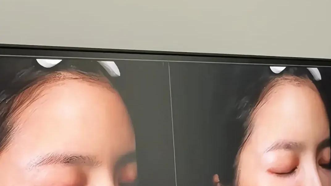 杜淳老婆去医院做美容，王灿大方晒激光美白过程，自夸皮肤好到爆