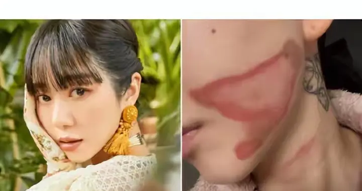 韩国歌手权珉娥自曝医美后毁容，醒来脸上撕裂般疼痛