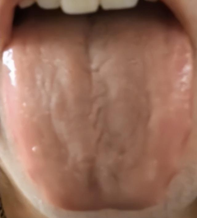 脾胃 吃得多不消化，减肥难怎么办？中医：胃强脾弱，先清胃热再健脾胃
