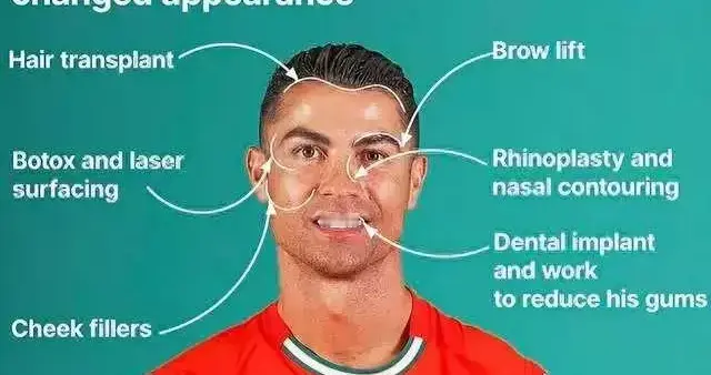 够狠！C罗为整容打断鼻梁 美国顶级整形医生：他面部基本都动过！