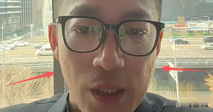 汪小菲忘开美颜满脸疤痕, S家和马筱梅难脱干系, 张兰位置意外曝光