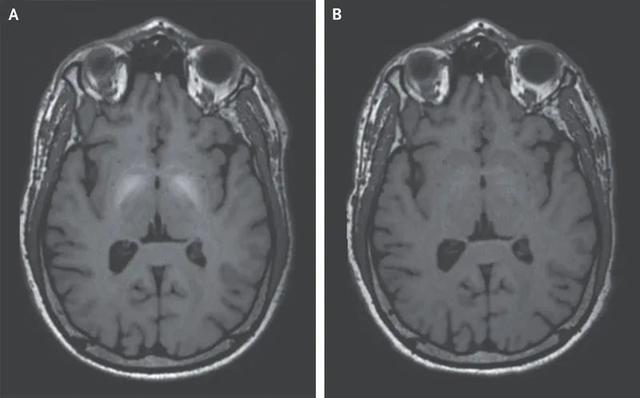 诊断帕金森病为什么要问职业史？（锰中毒）