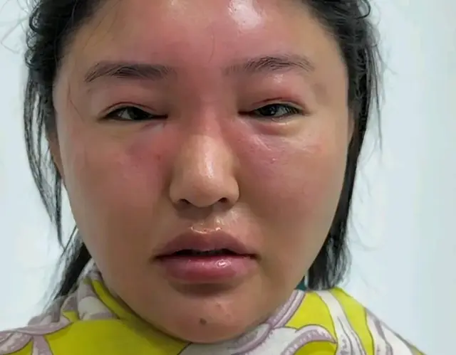 赵本山徒孙娇娇五一晒近照，全脸肿胀太吓人，网友：像猪头焖子！