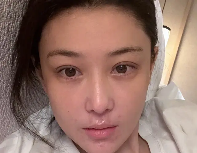 张馨予分享素颜近照，皮炎复发面部出现疤痕，透露爆发期很吓人！