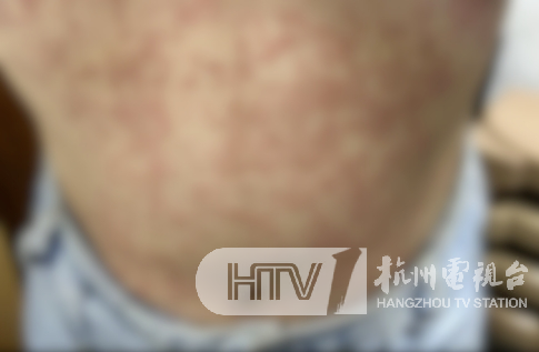 密密麻麻发满红疹…姑娘小伙都有中招！医生：赶紧停掉！