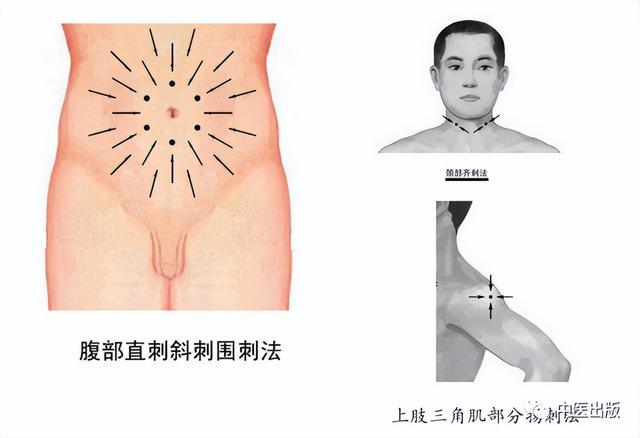 针灸 “不禁食、不反弹”的针刺减肥手法