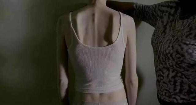 催吐、吃药、插胃管，北大六院的精神科，住满了减肥过度的女孩