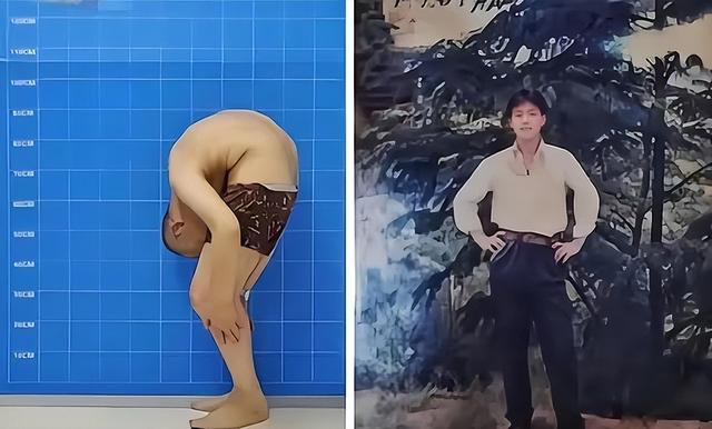 “被折叠的人”，为重获新生，截断骨头4次、植入22颗钢钉