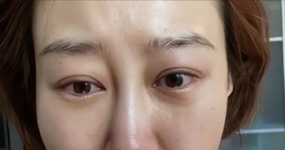 满是心酸！38岁过气女星失业，住80平出租屋，下巴也被玻尿酸打坏