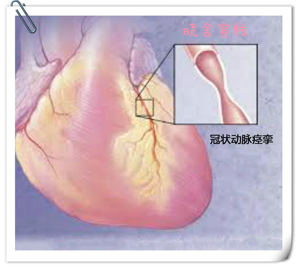冠状动脉痉挛导致心肌缺血,心绞痛,心肌梗死,猝死!