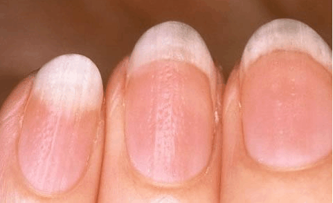 指甲变化提示十种疾病