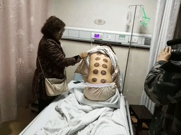 花8800多元拔火罐, 把自己拔进了医院, 拔火罐应该注意什么