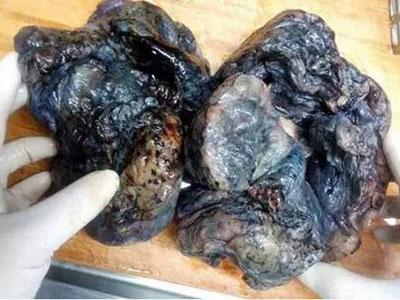 吸烟与不吸烟肺部恐怖差别