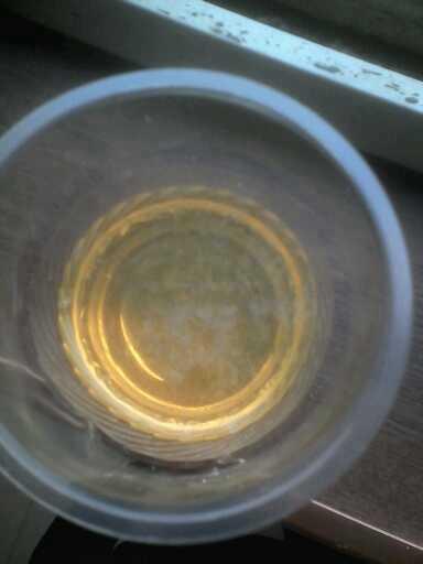 如果尿液和酒精混合后,液体变得浑浊,出现类似渣滓的沉淀物,但是液体