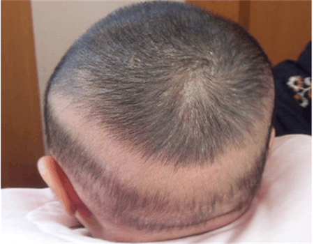 宝宝掉头发是怎么回事?