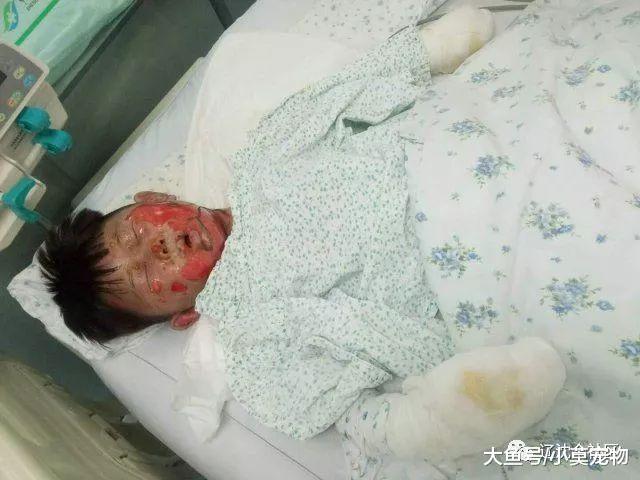 轰的一声! 锅炉爆炸四个孩子被严重烫伤