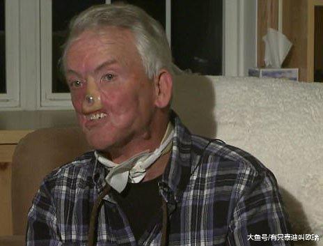 猎人遭到母熊攻击「脸部被毁烂」, 捡回「鼻子嘴巴重建」连吃饭也要从头学