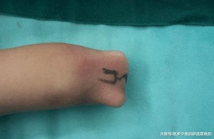 宝宝出生时才发现少一只手吓坏医生, 结果竟是孕妇这种恶习导致