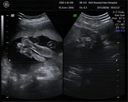 正常胎儿和唐氏儿四维图片