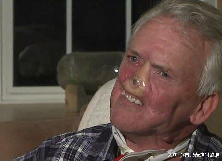 猎人遭到母熊攻击「脸部被毁烂」, 捡回「鼻子嘴巴重建」连吃饭也要从头学