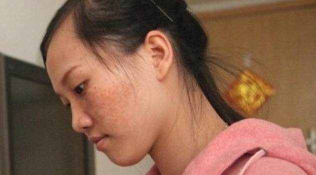 脸上长斑，用维生素E擦就可以了吗？皮肤科教授说了实话