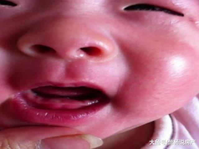 奶奶用毛巾擦了宝宝这个部位, 导致宝宝患上败血症, 家长别大意