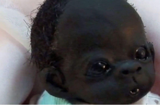 当年被誉为“世界最黑的婴儿”，4年过去了，现如今过得怎么样了