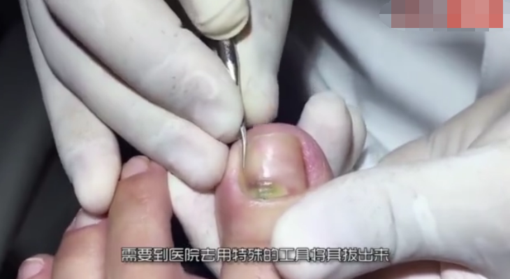 指甲往肉里长怎么办？有了这个小工具，甲沟炎无需手术了！