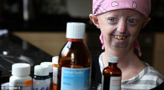 世界上老的最快的女人，19岁的年龄却拥有150岁的身体，衰老而亡