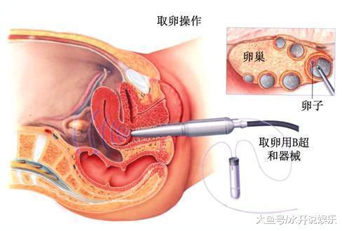 揭秘试管婴儿全过程（附图），看完后心疼女性一万遍