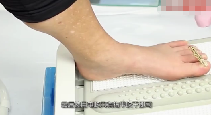 指甲往肉里长怎么办？有了这个小工具，甲沟炎无需手术了！