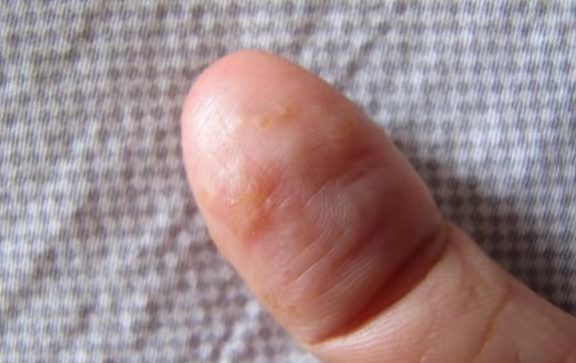 手脚长出很多“小水泡”，一抓还很痒是什么原因？幸好知道不晚