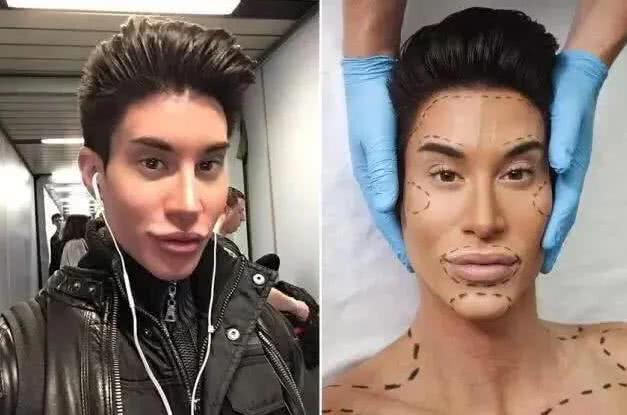 整形|还记得那个整形一百多次的男人吗？花154万给后背植入翅膀，今状况如何？